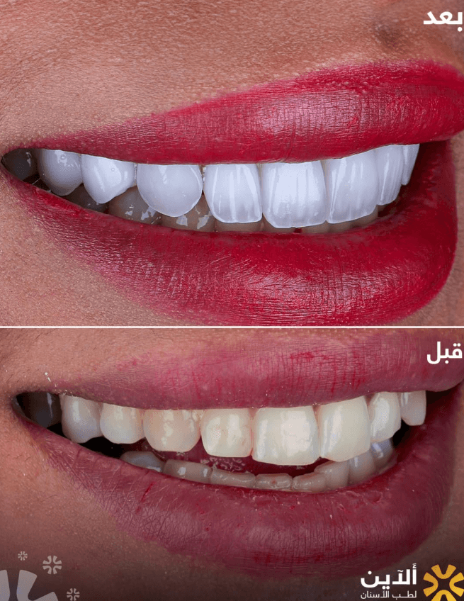 نتيجة ابتسامة 1