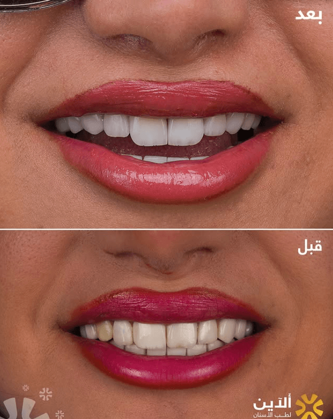 نتيجة ابتسامة 2
